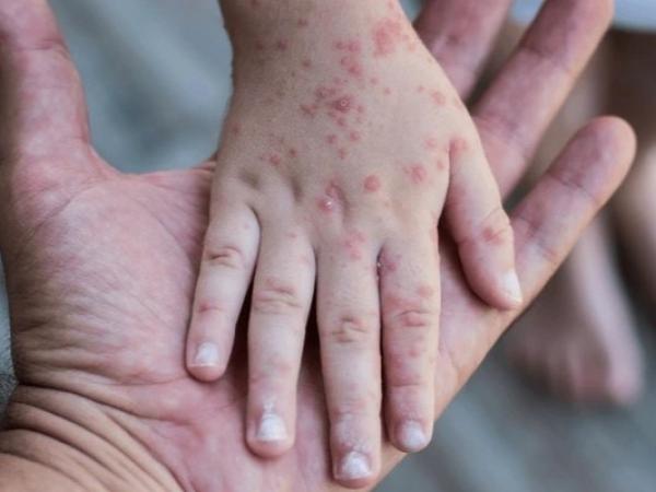 Gobierno mantiene atención en escuelas ante brotes de coxsackie